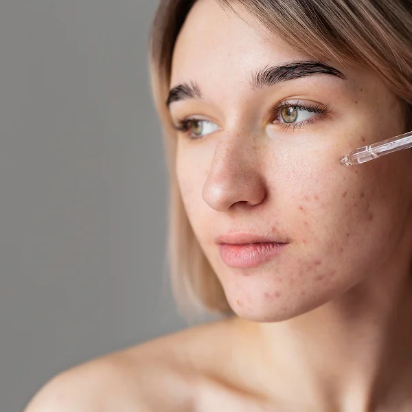 Une femme avec de l'acné sur le visage tient une seringue, mettant en avant un produit anti-acné.